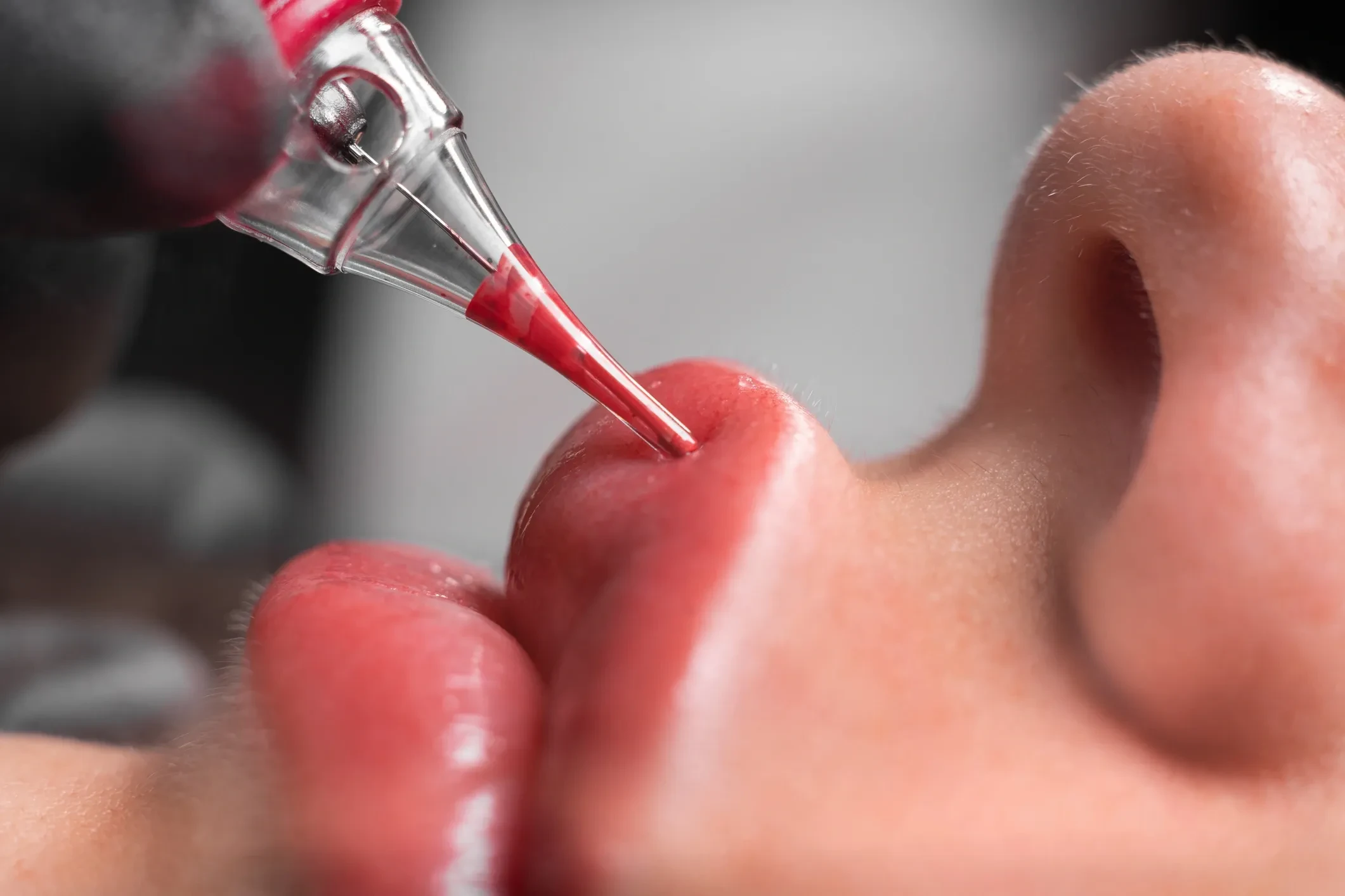 Lip pigmentation needle close-up — The Needle Clinic