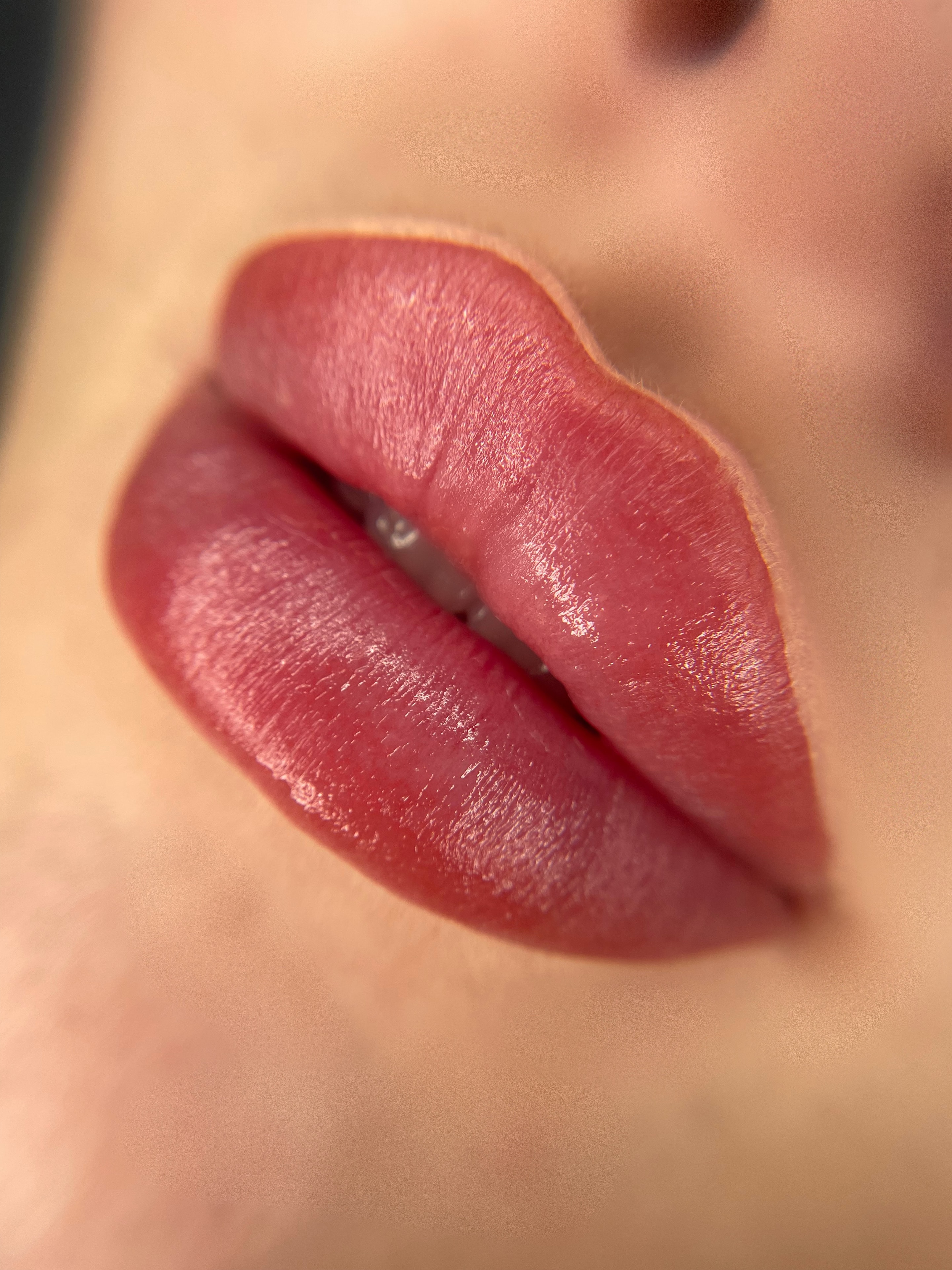 Lips treatments at The Needle Clinic